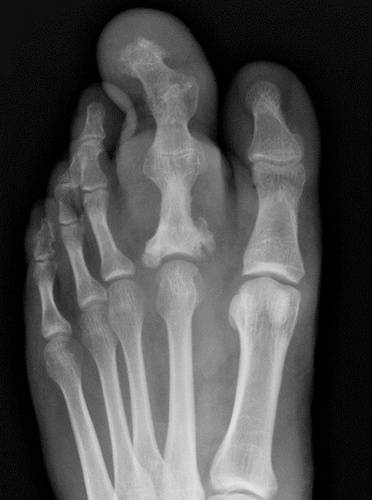 Macrodistrofia lipomatosa del pie: reporte de un caso de hallazgos histológicos y de resonancia magnética que incluyen anomalías del corpúsculo de Pacini
